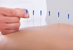 Dry Needling -Lusaka